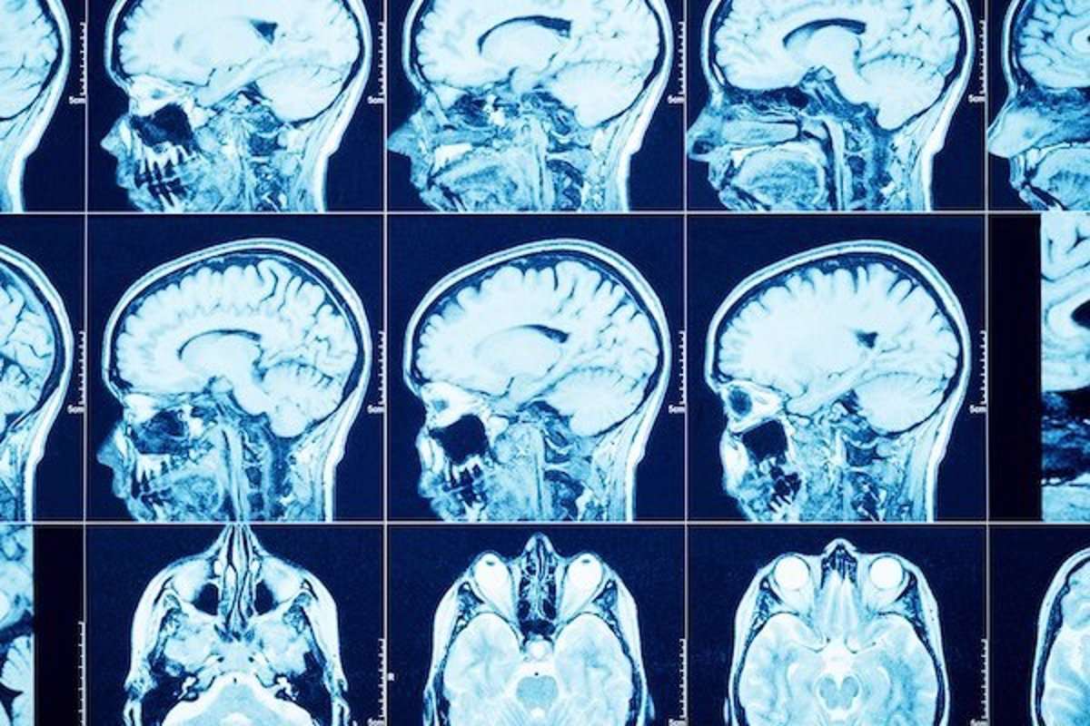 Guzy mózgu, infekcje i padaczka puzzle online