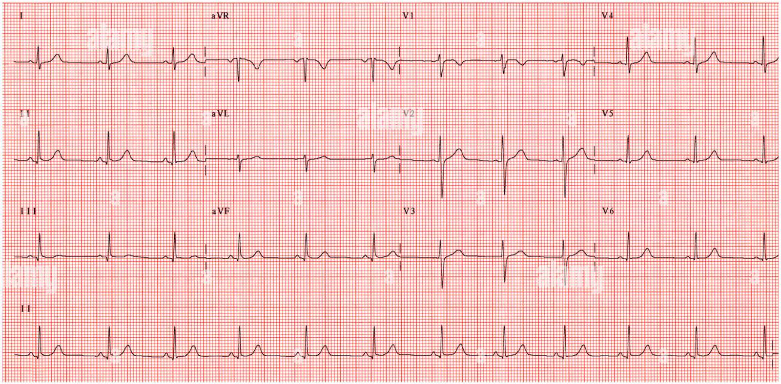 EKG patológico lub normalne puzzle online